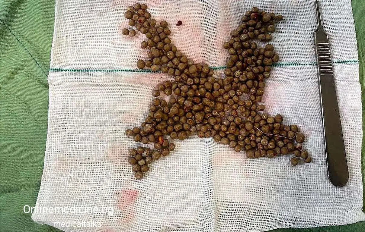 Клиничен казус 5: Медици изваждат над 200 бъбречни камъни от пикочен мехур